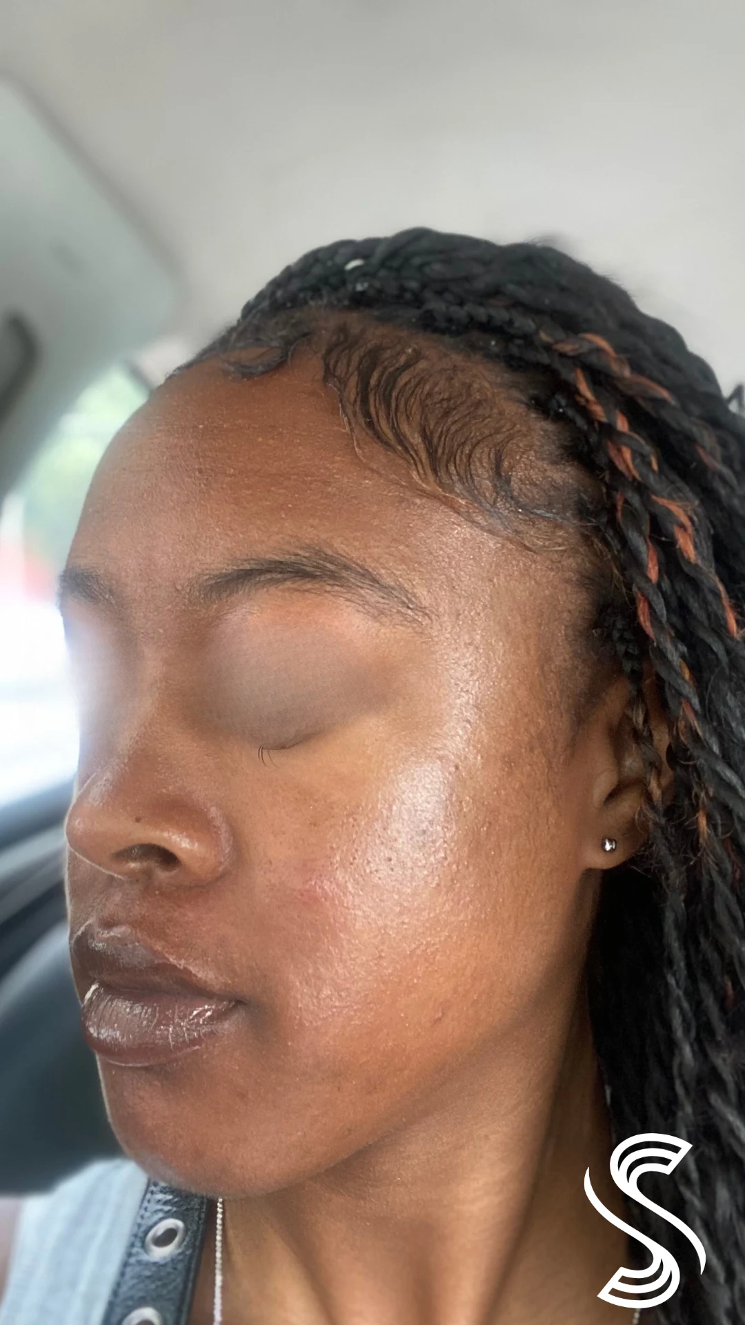 Hormonal Acne & Hyperpigmentation — after