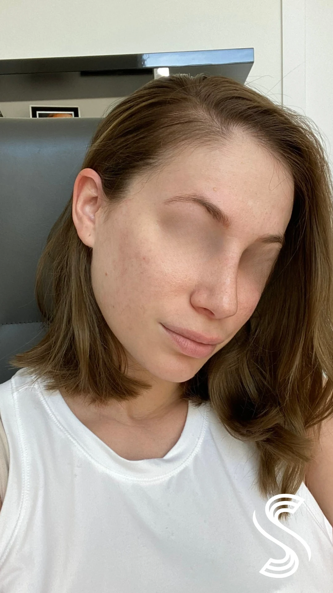 Hormonal Acne & Hyperpigmentation — after