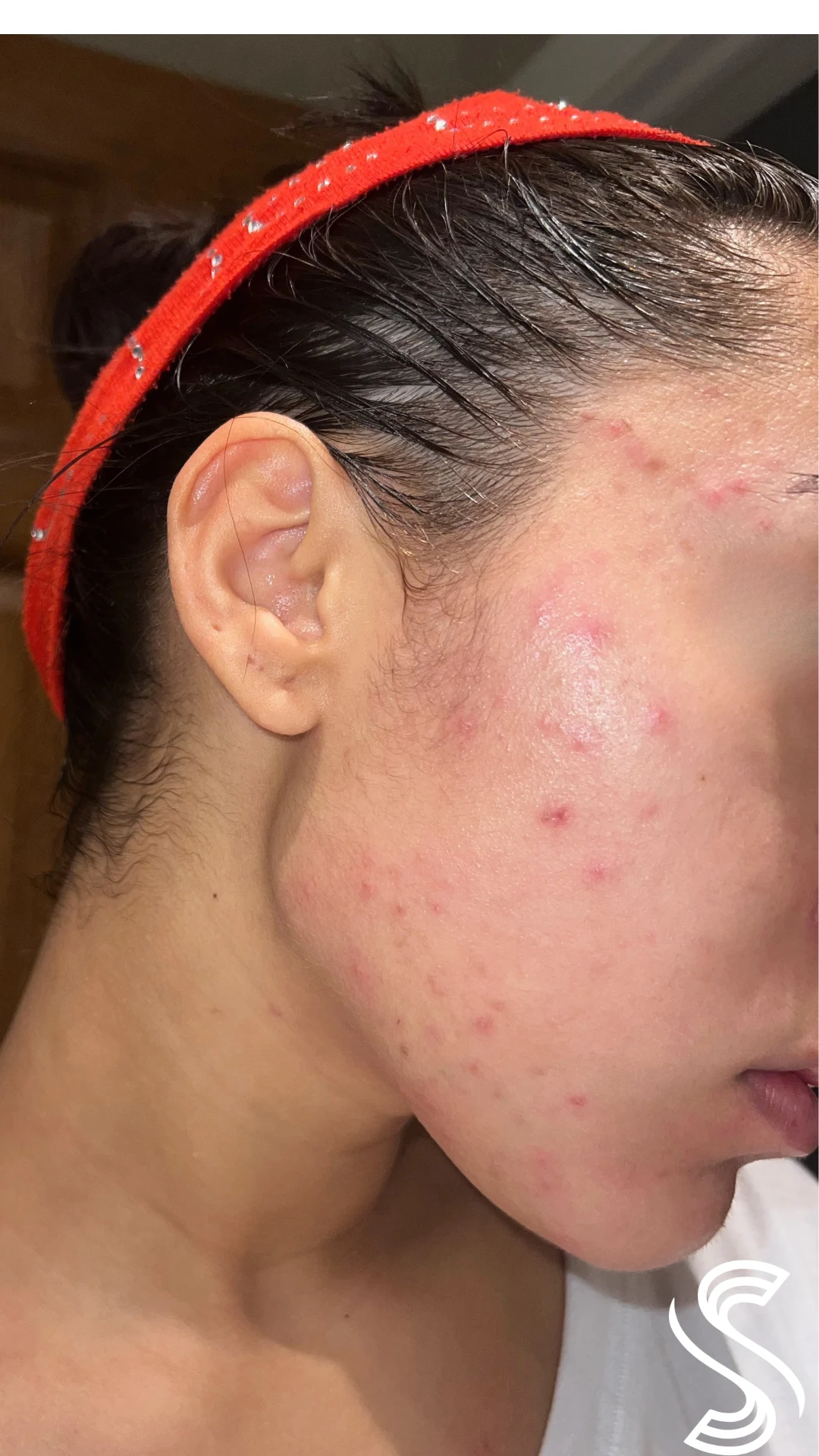 Client before photo — Cutibacterium Acne & Hyperpigmentation