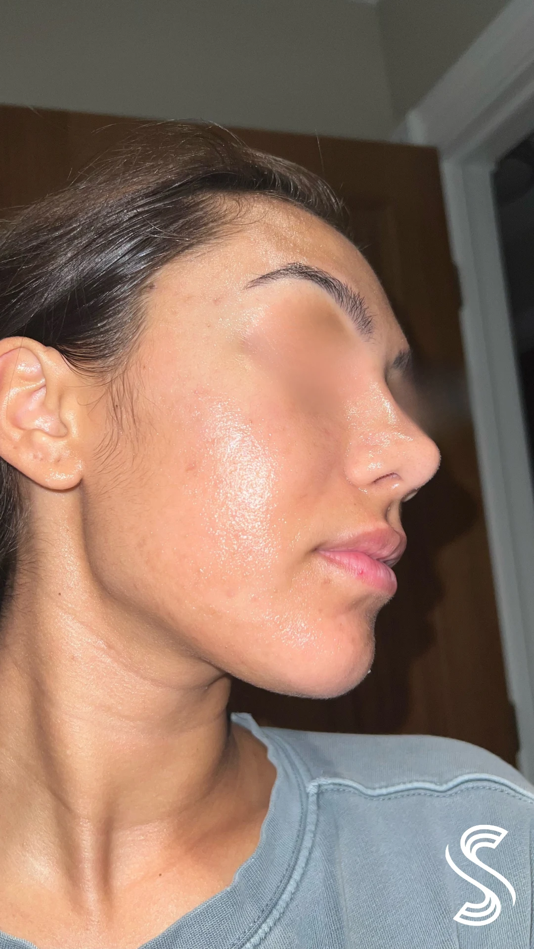 Cutibacterium Acne & Hyperpigmentation — after