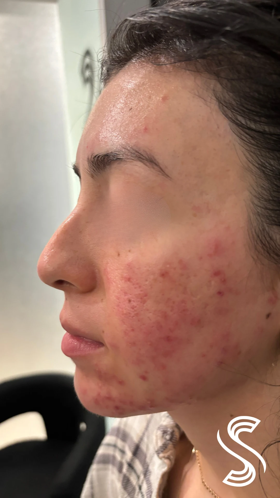 Client before photo — Hormonal Acne, Hyperpigmentation & Acne Scars