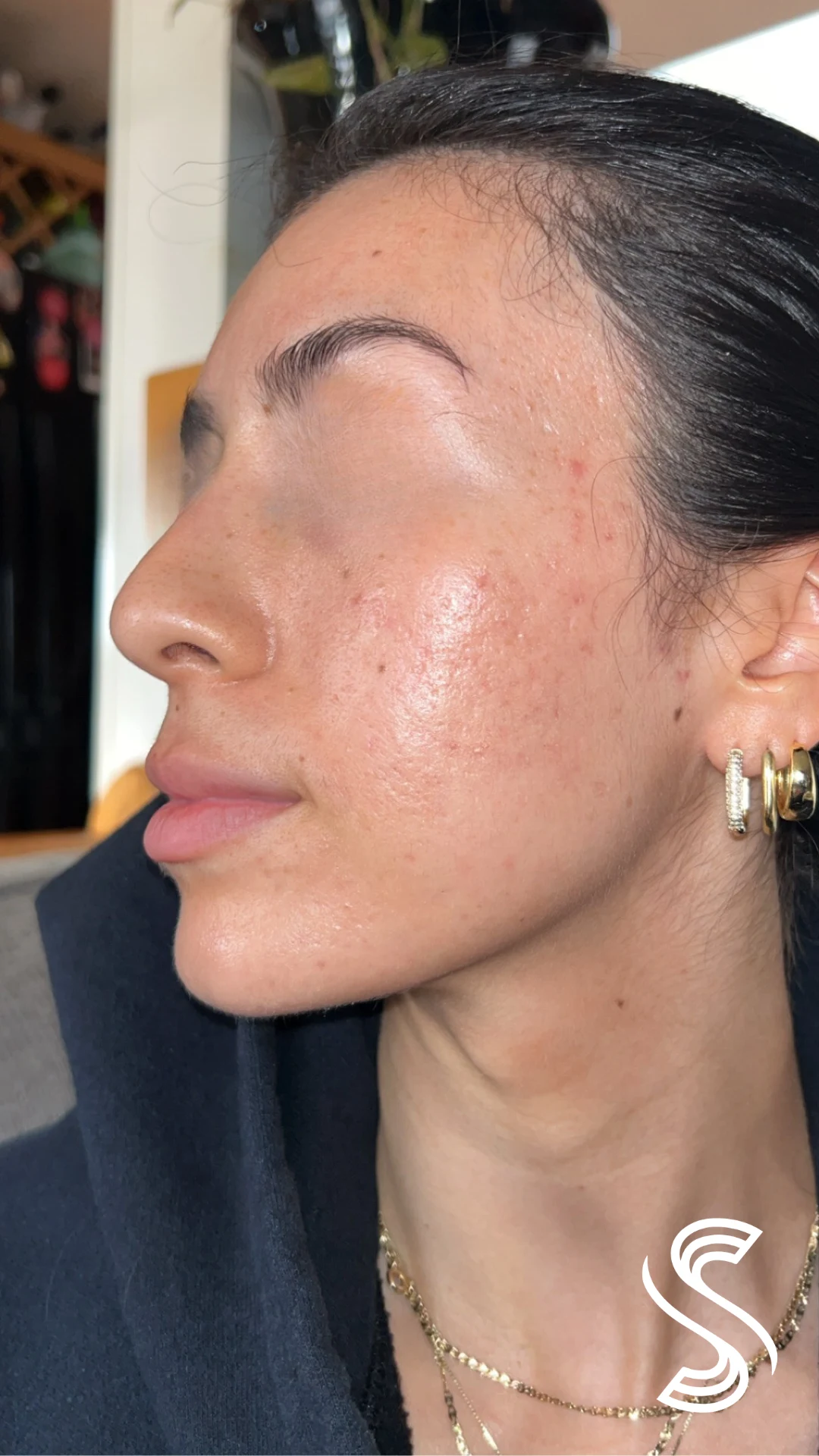 Hormonal Acne, Hyperpigmentation & Acne Scars — after