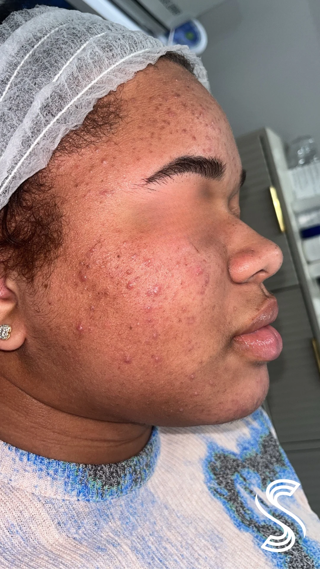 Client before photo — Fungal Acne & Hyperpigmentation