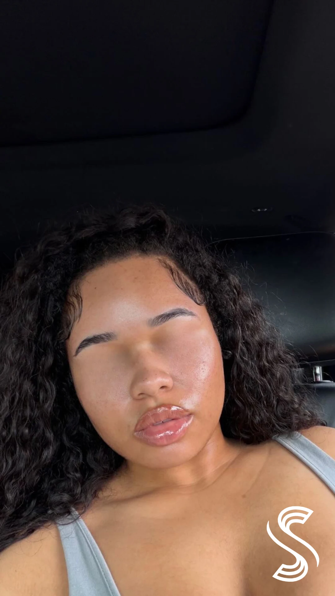 Fungal Acne & Hyperpigmentation — after